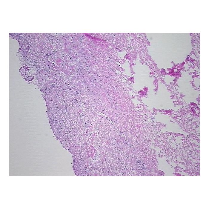 Frozen Tissue Sections, Metastasis, unknown source, CS514911 | Amsbio